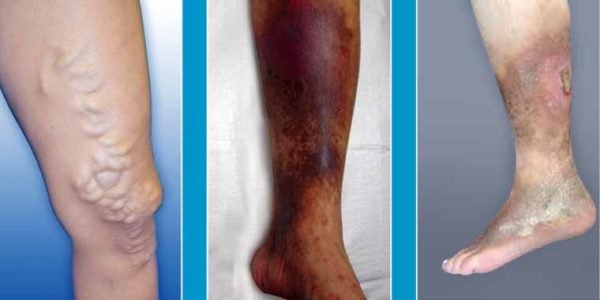 Risk Factors of Varicose Veins - Varicose Veins & Wound Clinic, Vasai