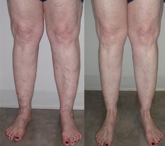 before-after varicose veins