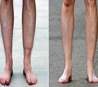 before-after varicose veins