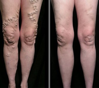 before-after varicose veins