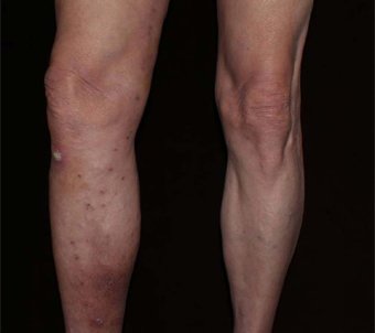 before-after varicose veins