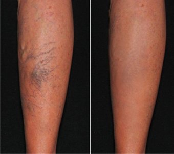 before-after varicose veins