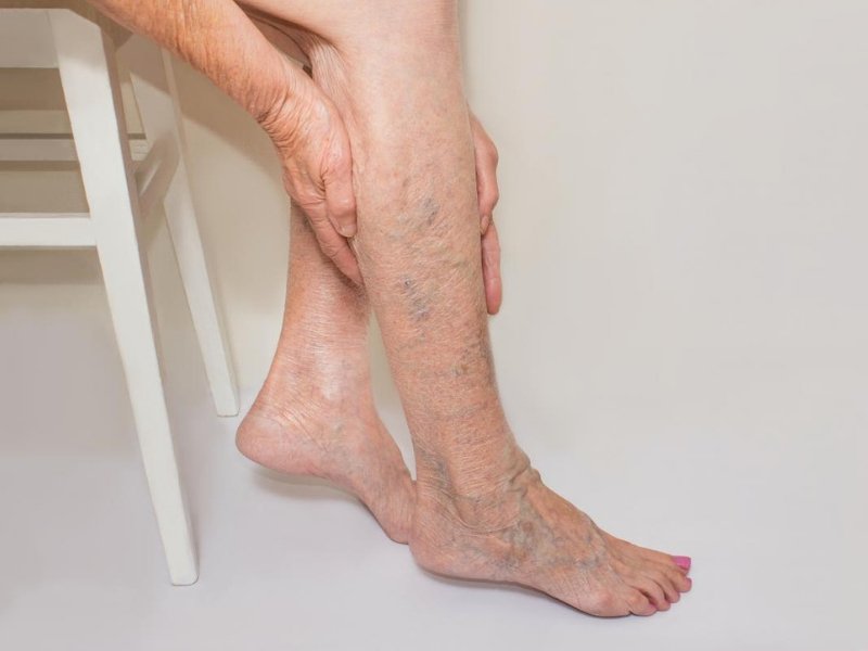Why do Varicose Veins Ache Most at Night?