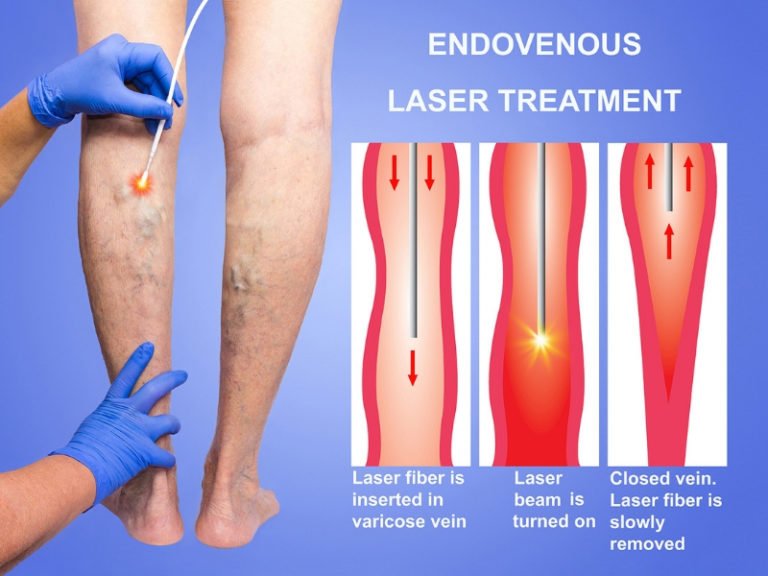 Medical Procedures For Varicose Vein Treatment Varicose Veins