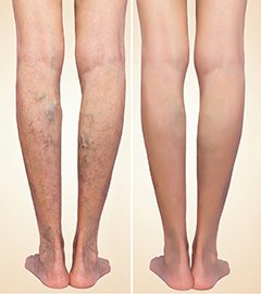 Early stages of varicose veins - Symptoms and Causes - Varicose Veins