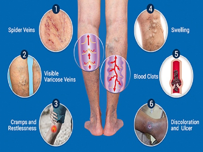 Varicose veins: Causes, Symptoms, Treatment, Diagnosis, and Prevention