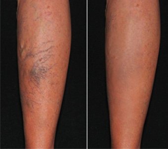5 Tips To Help You Prevent And Reduce Unsightly Varicose Veins